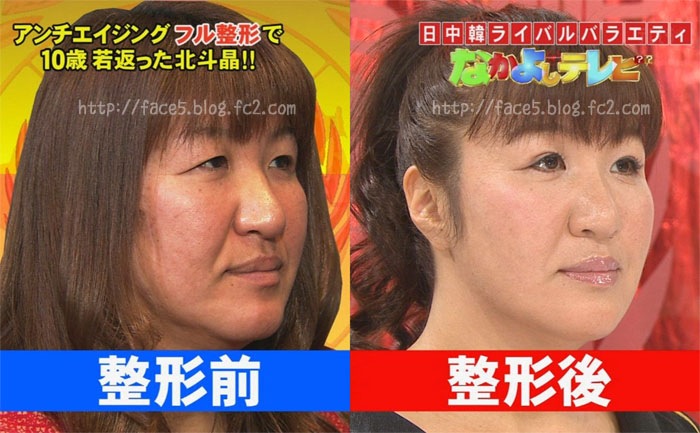 北斗晶の整形後(拡大表示)
