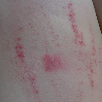 虫刺され Insect Bites 国ぎわ族 修行帖