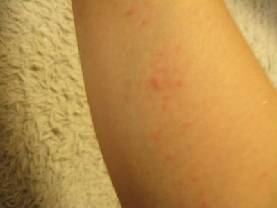 2457ちんこ の 付け根 が かゆい ドラッグ