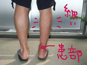 アキレス腱断裂57日目 浜なし ちゅら亭