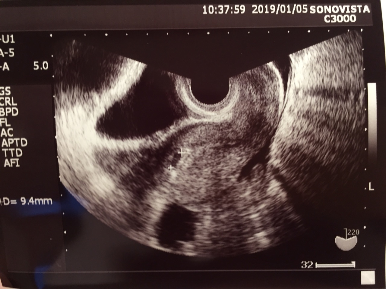 転院 K Clinic五周期目 Bt17 5週と0日 胎嚢確認 隣の見えないコウノトリ 33歳下垂体性無月経の1人目日記
