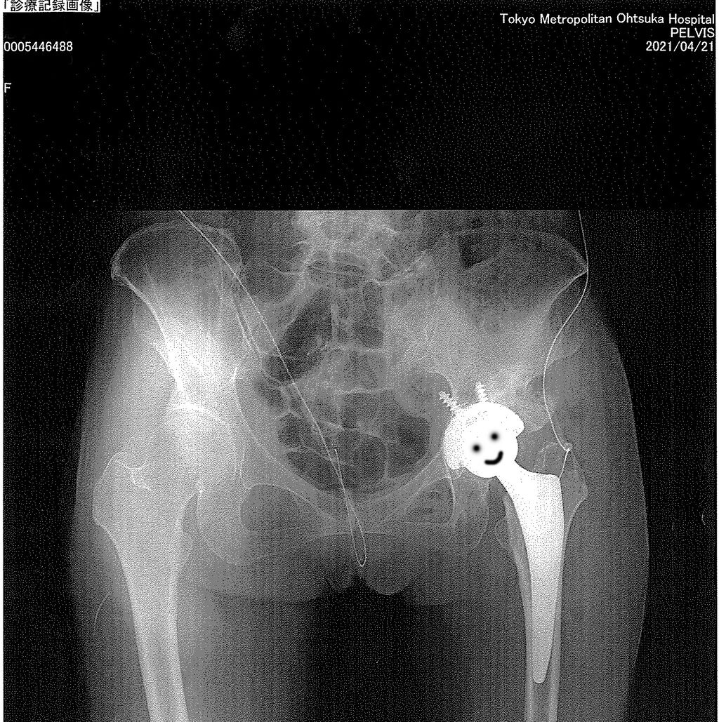 人工股関節 かわいい From Butthole With Love 人工股関節 かわいい From Butthole With Love