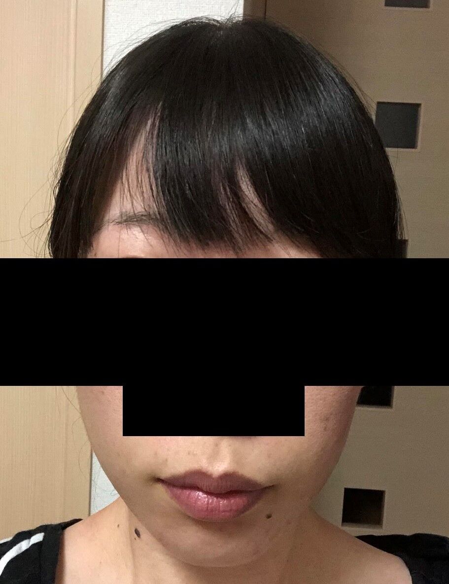 顔の歪み アラサーからの歯列矯正日記 顔の歪み アラサーからの歯列矯正日記
