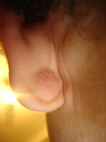 640px-Epidermal_Cyst_ear