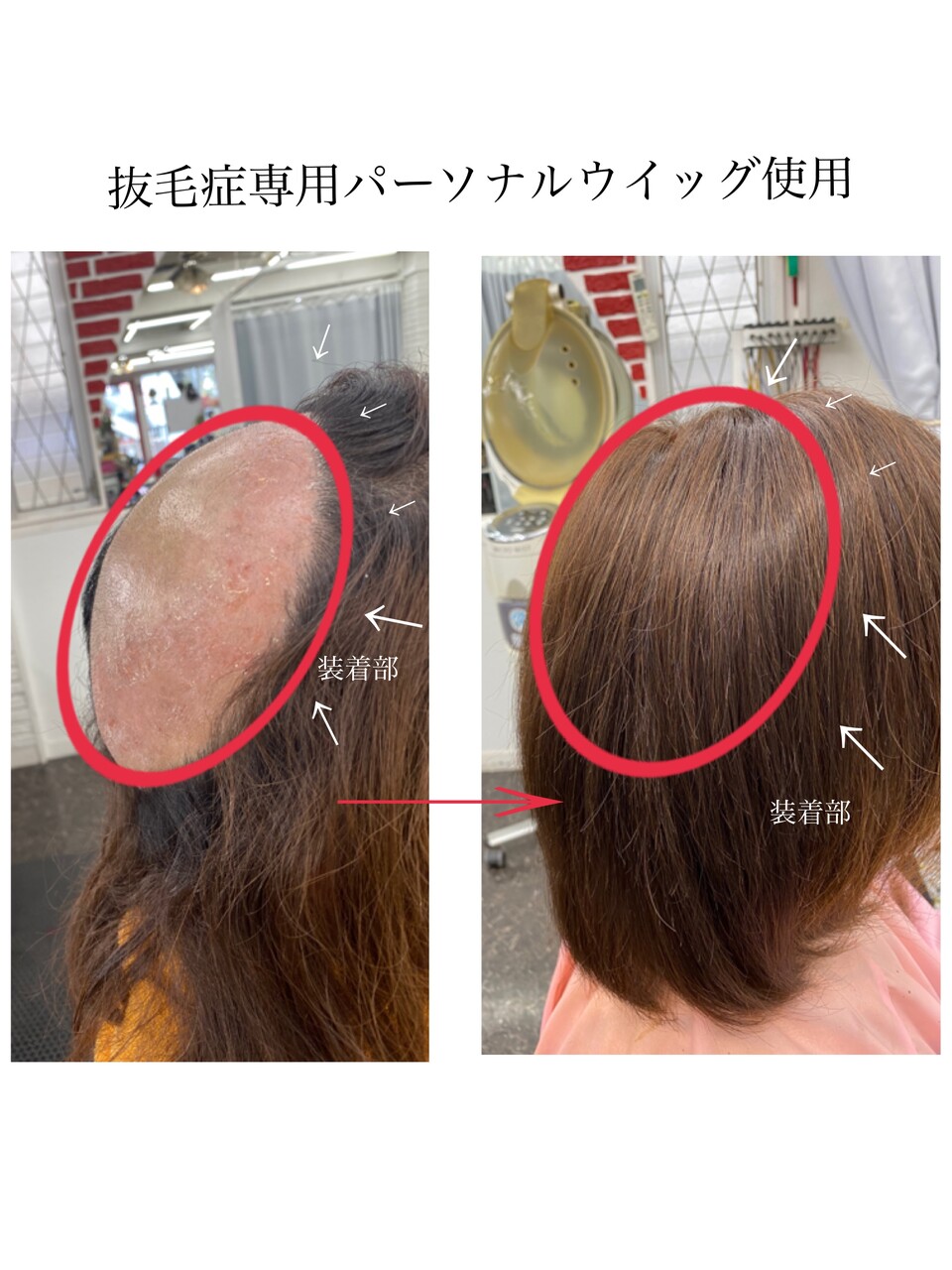 抜毛抑制ウィッグ | www.ofa.sg