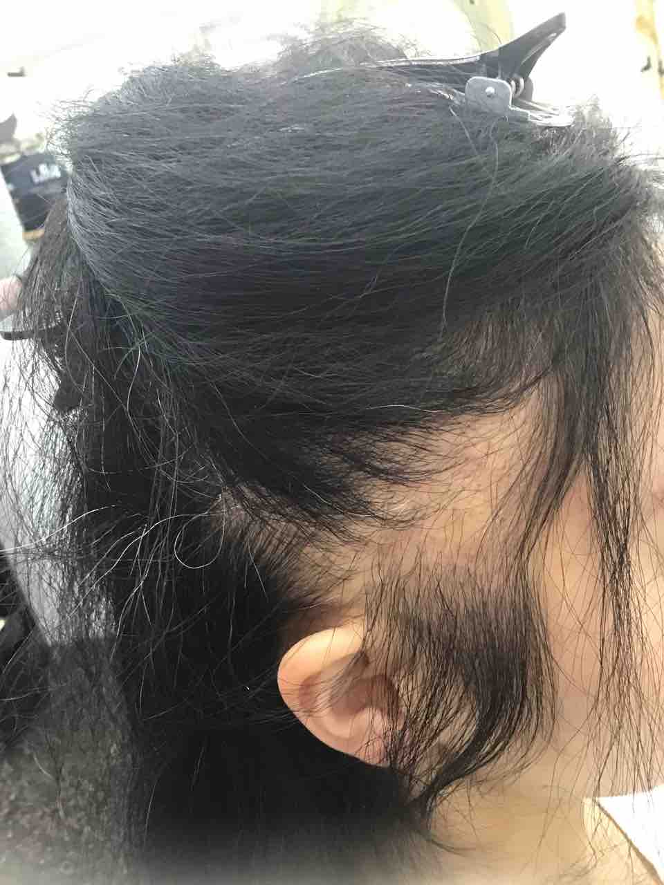 抜毛症に対応する美容師 神戸 紫光美容室