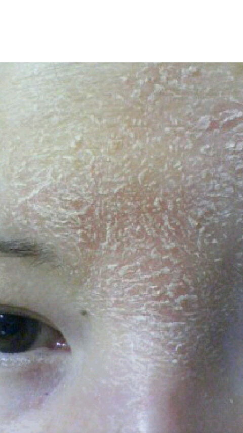 角質培養 美肌をとりもどせ 57皮目 コスメでブログ