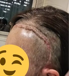 開頭手術後の白髪染め ヘアカラー について メメント モリ くも膜下出血サバイバー 開頭手術後の白髪染め ヘアカラー について メメント モリ くも膜下出血サバイバー