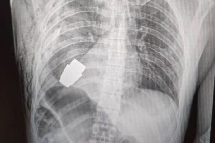 ウクライナ兵の胸に入った不発手榴弾の摘出手術に成功！