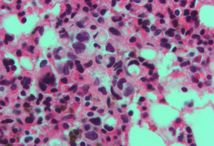 ロシアが遂に「がんワクチン」開発に成功か…60～80%で症状改善！