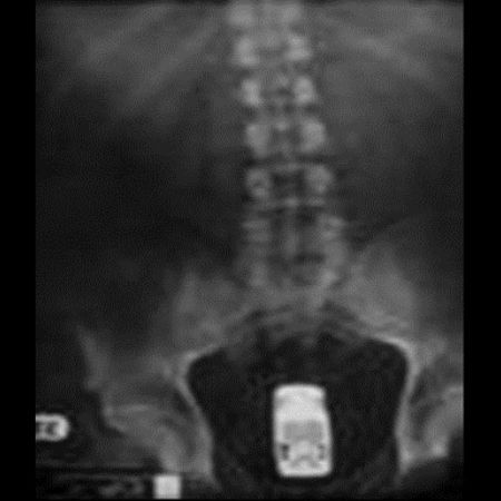 異物が体内に入ってしまったx線映像 きまぐれログ