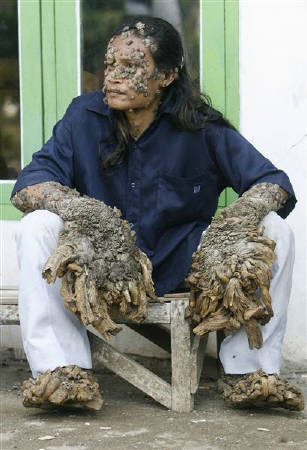 両手足がこぶに覆われたインドネシア人男性 米医師が治療へ ちょっと 気まぐれフォト日記