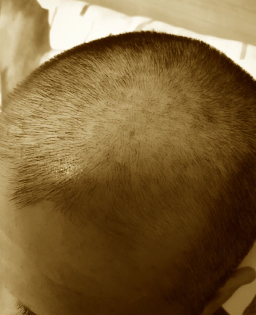 30年ぶりの 胃がん克服までの道のり