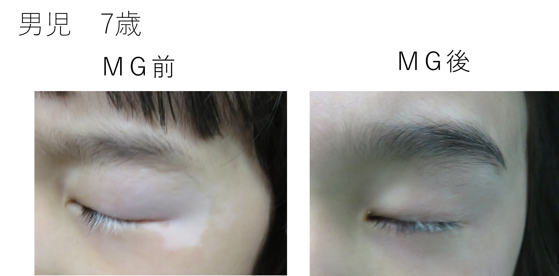 目にも白斑があるのですが効果あり｜白斑を家庭用ナローバンドUVBで治療中 | 白斑日記