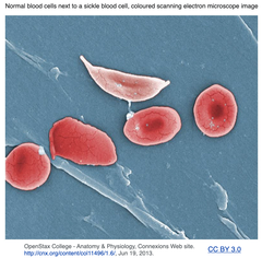 HPFH3遺伝子のCRISPR-Cas9 GEによりγグロビンの発現を誘導し, 鎌状赤血球症およびβサラセミアの表現型を改善