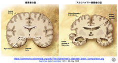 鼻腔ブラシ生検でアルツハイマー病 (AD )の兆候を早期に捉える