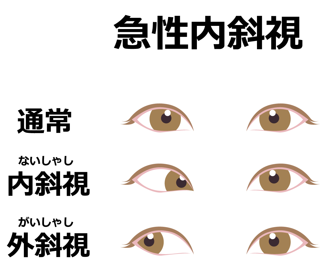 【画像12枚】内斜視の可愛さは異常 : 気になる芸能まとめ
