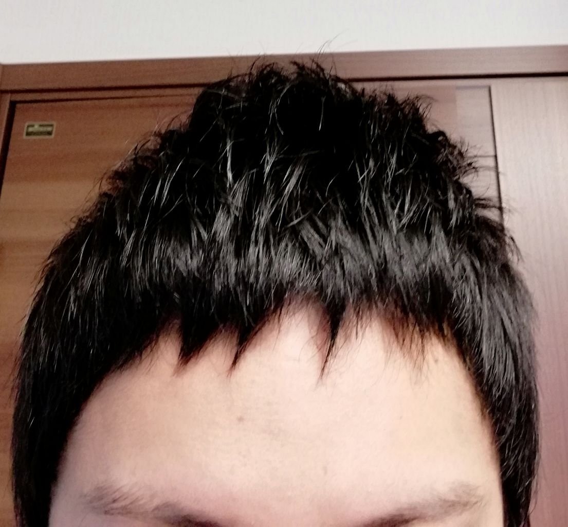 植毛やっぱやめようかなぁと思った話 植毛資金は暗号通貨で