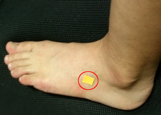 疲労の向こう側へ 足痛 短腓骨筋腱付着部炎かな 疲労の向こう側へ 足痛 短腓骨筋腱付着部炎かな