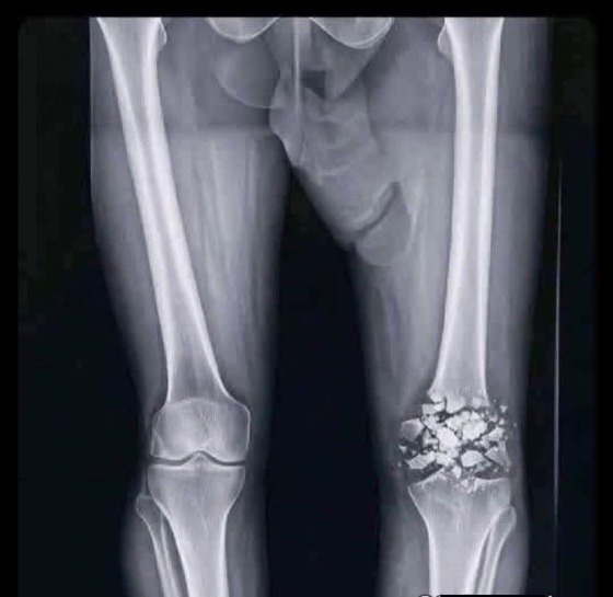 【悲報】ワイ、バイクで骨折…一生治らないのサムネイル