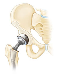 14年3月25日 ドーピング目的のアナボリック ステロイド常用が引き起こす大腿骨頭壊死などの 股関節の故障 について Damejima S Hardball