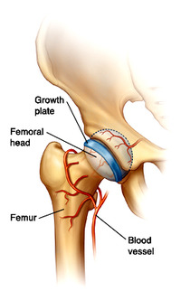femoral head¡ÊÂçÂܹüƬ¡Ë