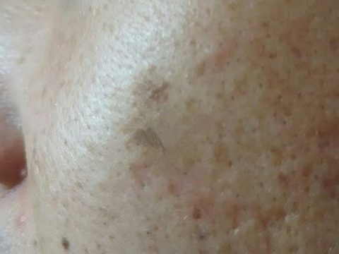 ルミキシルブライトニングクリームを使用して一ヶ月