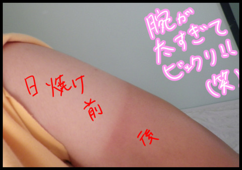 日焼け