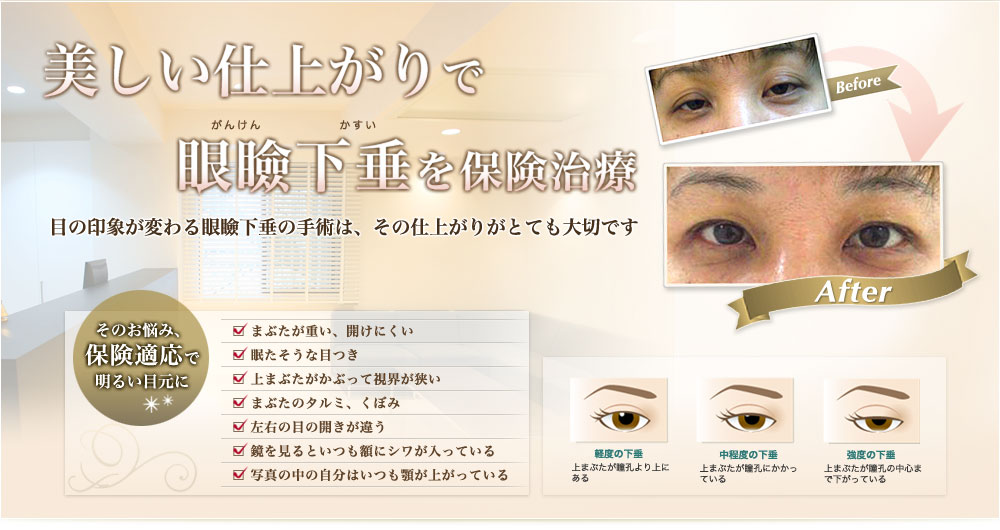 目のたるみ 不快 眼瞼下垂 ミニママのblog 目のたるみ 不快 眼瞼下垂 ミニママのblog