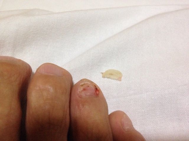 爪剥がれる、、、 : davidnuuhiwaのblog