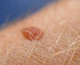 腕にホクロが◯◯個以上あると皮膚がんになる可能性が高いことが判明