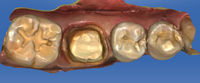 cerec-klinischer-fall-Ehrlich-2
