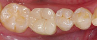 cerec-klinischer-fall-Ehrlich-7