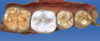 cerec-klinischer-fall-Ehrlich-4