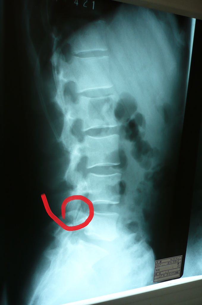 ルート２の語呂合わせ と 第五腰椎分離症 怜悧玲瓏 高校数学を天空から俯瞰する