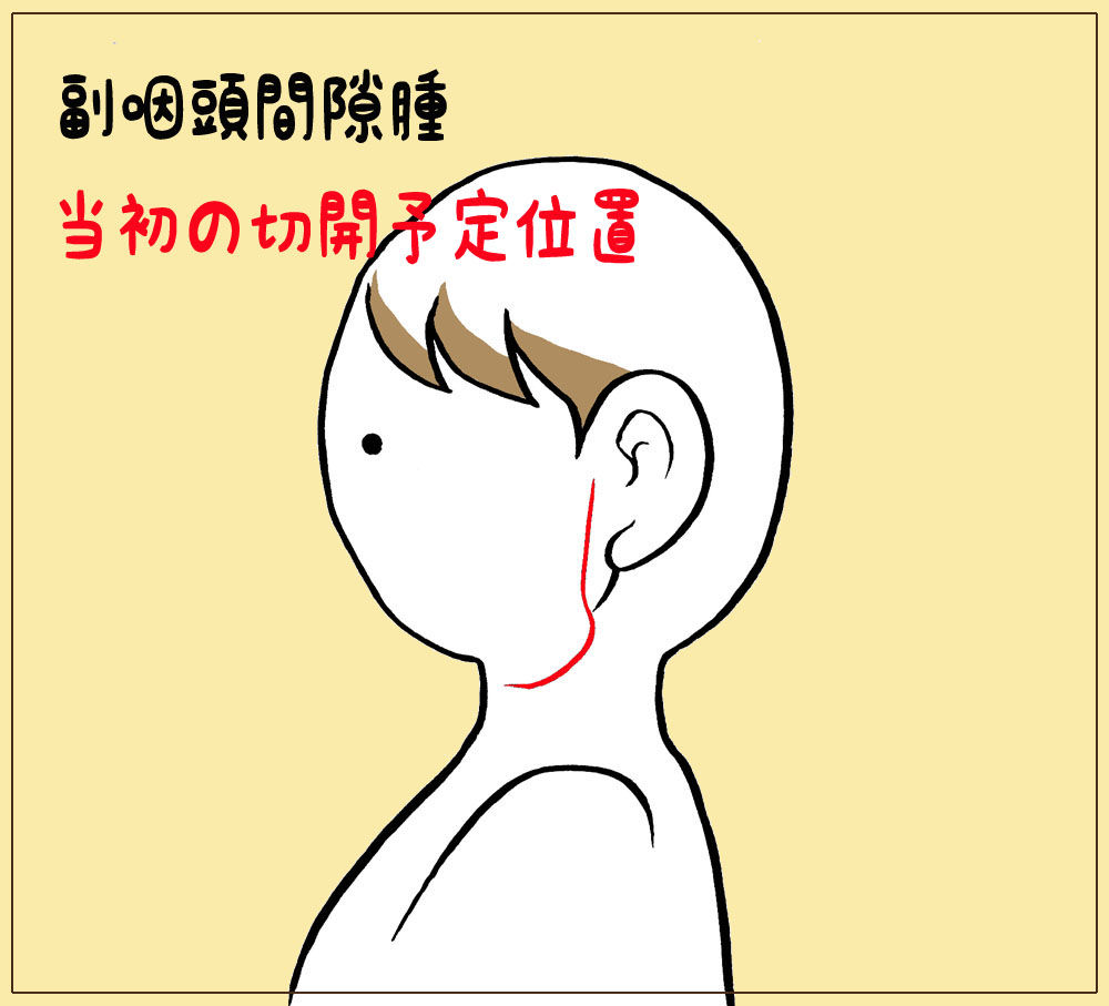 副咽頭間隙腫瘍 執刀医の先生からの大事なお話し でこぼこ道に花の種