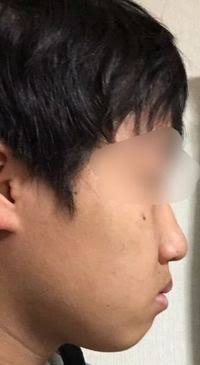 画像 口呼吸 を矯正されなかった子供たちの末路が悲惨すぎると話題に 匿名だって真剣