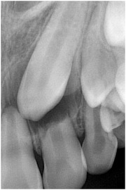 側切歯吸収デンタル
