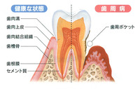 歯肉溝