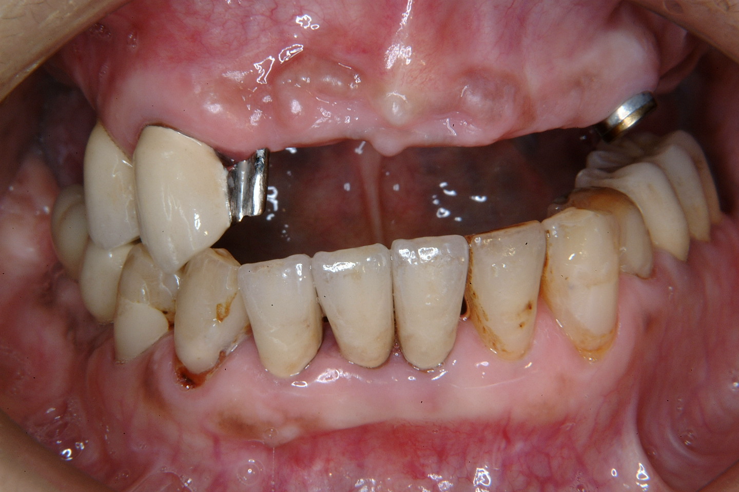 入れ歯とインプラントを併用した治療例 口元を隠すハンカチはもう要らない ２ 長持ちする歯科治療を望む方の歯科医院 池袋の歯医者 萩原歯科医院のブログ