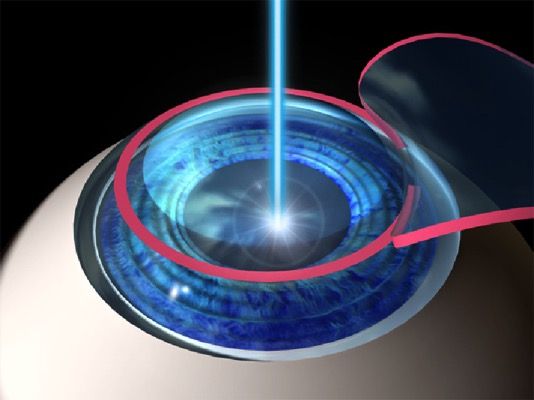 lasik-procedure00_Gaussian_smallbeam.jpg Lasik procedure00 Gaussian smallbeam