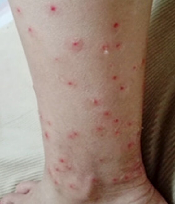 虫の嫌いな人は閲覧禁止 起床時の気象病と 恐ろしい虫刺され ヌカカ シェルティ こむっ 虫の嫌いな人は閲覧禁止 起床時の気象病と 恐ろしい虫刺され ヌカカ シェルティ こむっ