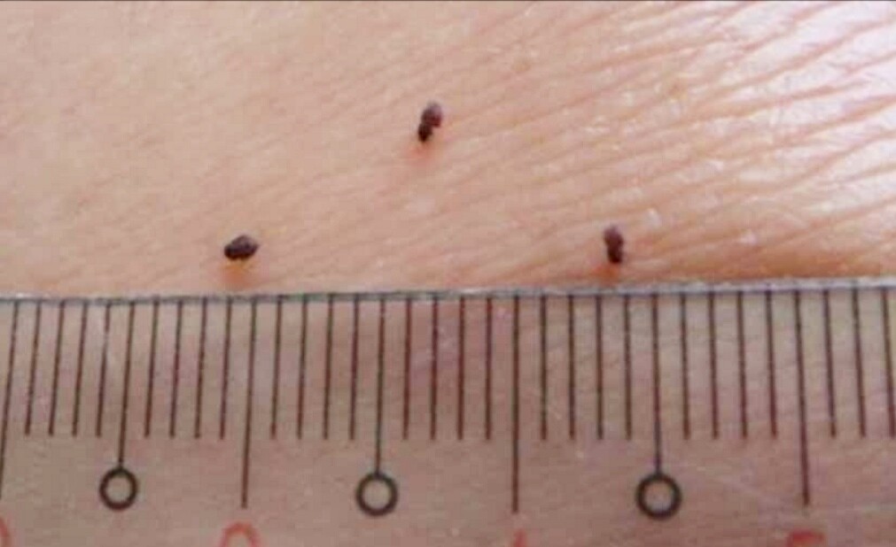 虫の嫌いな人は閲覧禁止 起床時の気象病と 恐ろしい虫刺され ヌカカ シェルティ こむっ 虫の嫌いな人は閲覧禁止 起床時の気象病と 恐ろしい虫刺され ヌカカ シェルティ こむっ