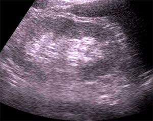 尿路結石による水腎症 とよない院長ブログ
