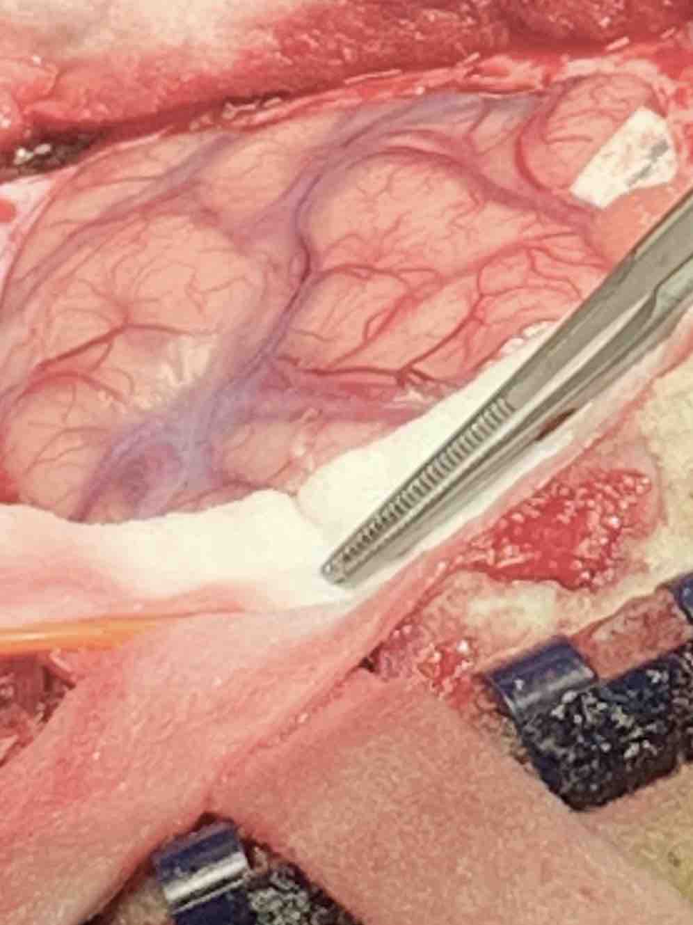 脳のエイジングとがん 脳腫瘍手術 脳のエイジングとがん 脳腫瘍手術