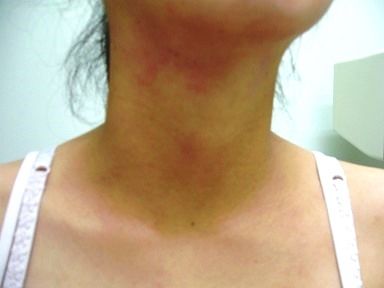 若い女性のアトピー性皮膚炎に対する開業医の責任は重大 ドクター康仁 こうじん のうんちく漢方塾