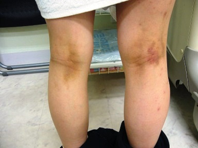 色素性痒疹 丘疹性痒疹 色素性痒疹图片 单纯性痒疹