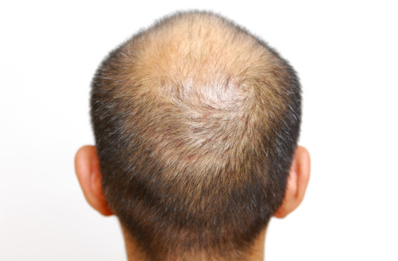 【悲報】すぐフサフサになると誤認させる広告を出した育毛剤会社、景表法違反で措置命令ｗｗｗ