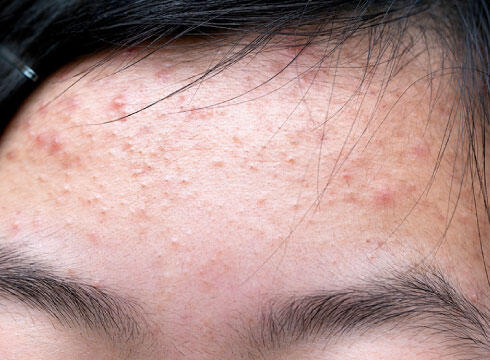 【悲報】「思春期ニキビ」とかいう本気で人生詰ませてくる要素ｗｗｗｗｗ