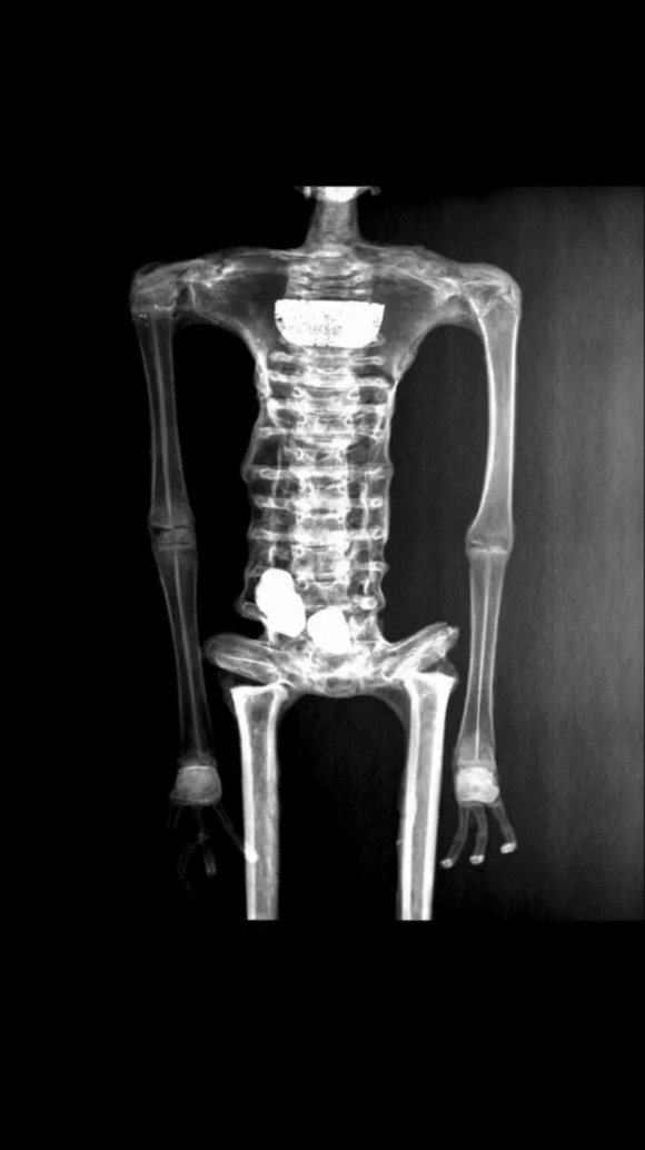 【画像】メキシコのミイラ、「人類ではない」地球外生命の可能性かｗｗｗｗｗｗ